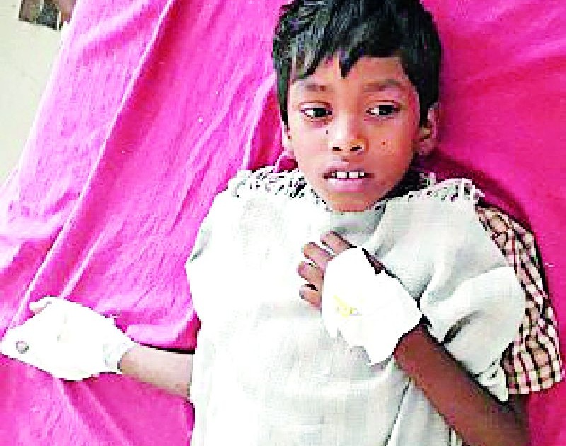 The child's hand was taken from the mobile battery | मोबाईलची बॅटरी फुटल्याने बालकाचा भाजला हात