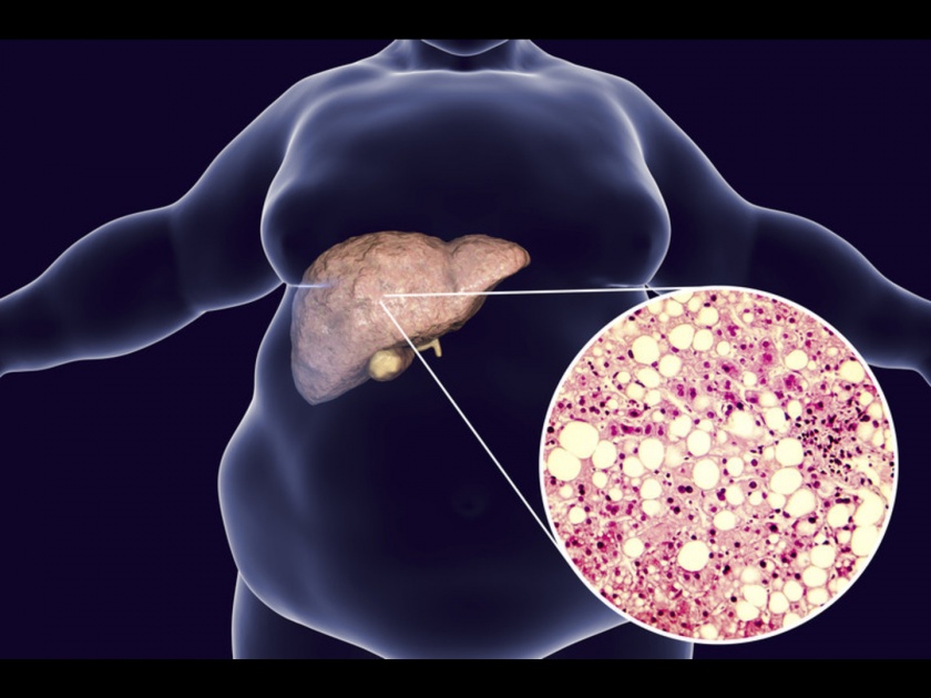 Fatty liver disease remedies you need to try now | फॅटी लिव्हर आजारापासून सुटका मिळवायचीये? हे सोपे उपाय ठरतील फायदेशीर