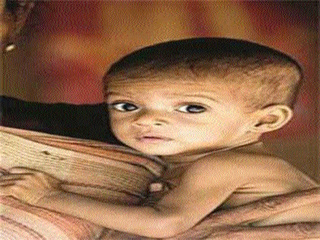 4,000 children in the district on the threshold of malnutrition | जिल्ह्यात २२ हजार बालके कुपोषणाच्या उंबरठ्यावर