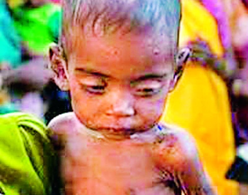 Malnutrition increased | कुपोषणाचे प्रमाण वाढले