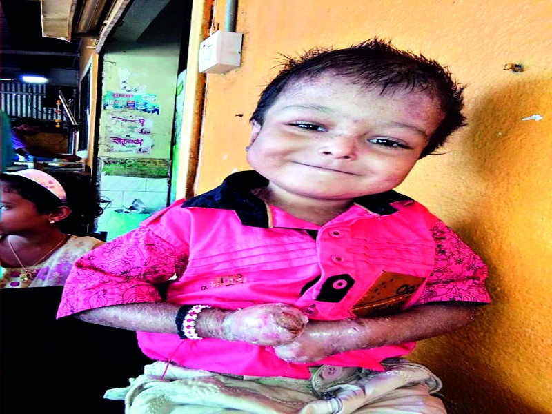 54 percent disability certificate given to 8 year old boy by Aundh Hospital | धक्कादायक! जीव टांगणीला, तरी म्हणे ५४ टक्के अपंगत्व..