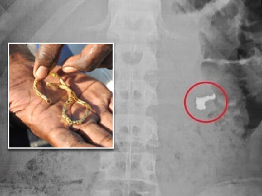 Brazil thief swallowed the gold chain snatched from the girl shocking xray viral | तरूणीची सोन्याची चेन गिळली, पोलिसांनी पकडल्यावर म्हणाला - काय पुरावा आहे?