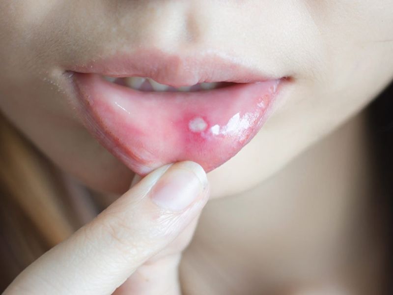 6 superb home remedies to get rid of mouth ulcers | सततच्या तोंड येण्याला वैतागलात, या घरगुती उपायांनी मिळवा आराम !