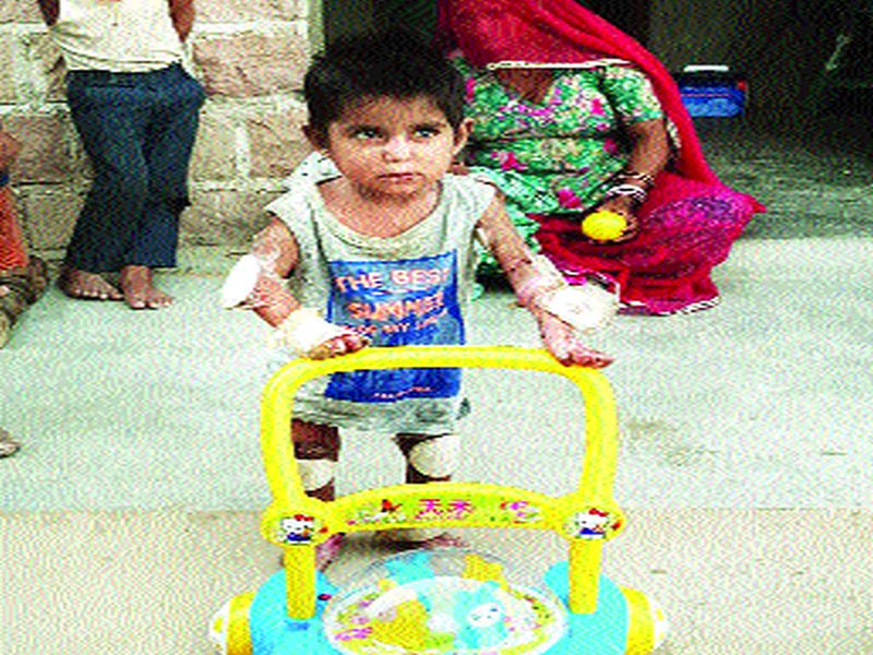 Successful treatment in Mumbai on 'Butterfly Baby', rare disease relief | ‘बटरफ्लाय बेबी’वर मुंबईत यशस्वी उपचार, दुर्मीळ आजारातून झाली सुटका