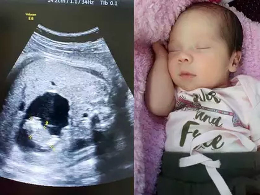 Colombian baby girl born twin inside her barranquilla | आईच्या पोटातील बाळाच्या पोटात भ्रूण, डॉक्टरांनी शोधलं 'सोल्यूशन'
