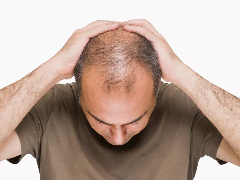 The biggest reason for baldness is the lack of nutrition, include these food in the diet | केसगळतीची 'ही' आहेत मुख्य कारणे, डाएटमध्ये 'या' गोष्टींचा समावेश करून कमी करा केस गळणे!