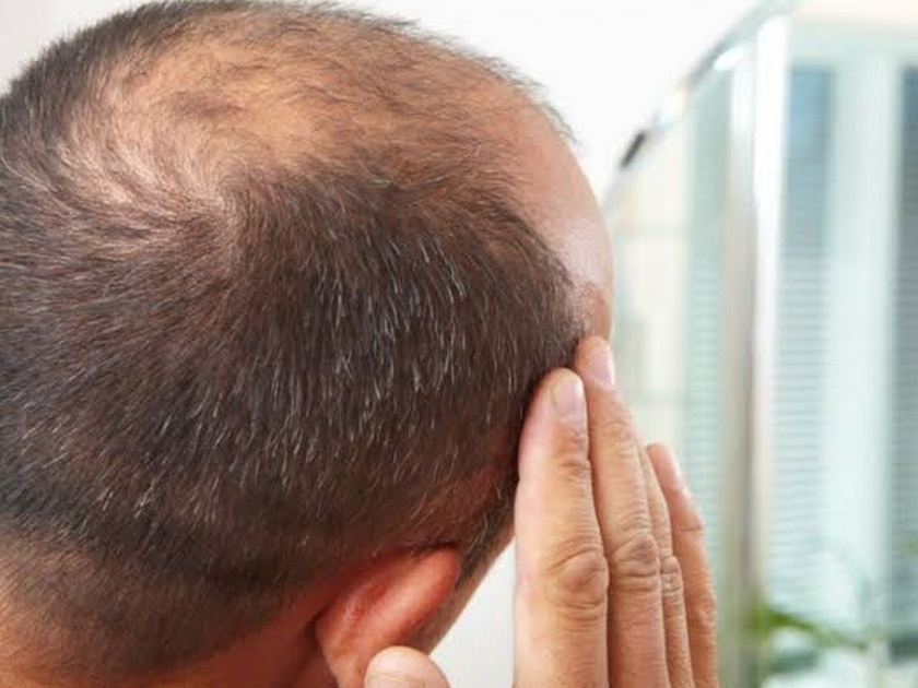 Working for more than 10 hours daily increases the risk of hair loss and baldness in men | पुरूषांच्या केसगळतीचं एक नवं कारण आलं समोर, दुर्लक्ष करला तर बसाल बोंबलत!