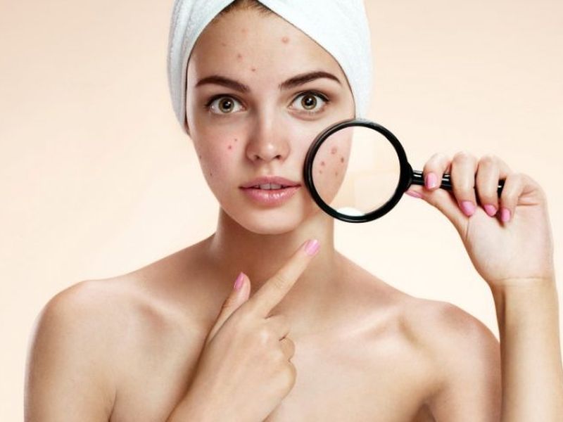 How to remove blackheads for glowing skin try these home remedies | चेहऱ्याची चमक कमी झालीये? ब्लॅकहेड्सने हैराण आहात? करा हे उपाय