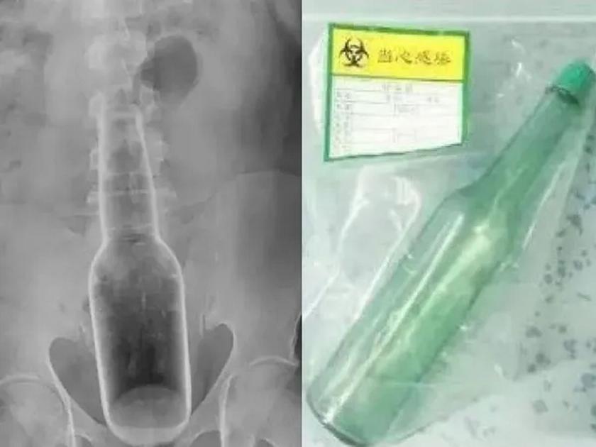 OMG! 7-inch-long bottle gets stuck in man's bottom after he uses it to scratch itch | बाबो! 'खाज' महागात पडली; ७ इंचाची बाटली पार्श्वभागात अडकली...