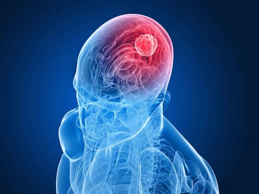 World Brain Tumor Day 2019: Know the seven symptoms of brain tumors | वर्ल्ड ब्रेन ट्यूमर डे 2019 : ब्रेन ट्यूमरची आहेत ही ७ लक्षणे, जाणून घ्या कशी कराल ओळख!