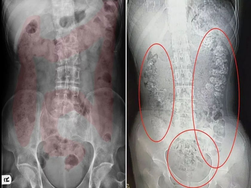 100 undigested bubble tea balls found in 14 years old girl stomach | १४ वर्षाच्या मुलीचं अचानक दुखू लागलं होतं पोट, सीटी स्कॅन केल्यावर डॉक्टर झाले हैराण!