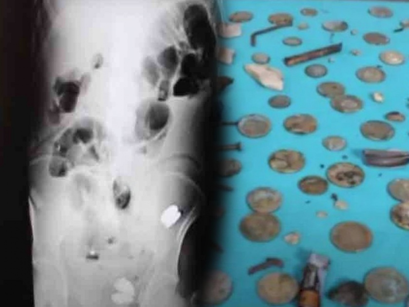 Nails, coins and glass found in man’s stomach, Doctor Shocked | व्यक्तीच्या पोटात सापडली 233 नाणी, बॅटरी, चुंबक अन् खिळे; एक्स-रे पाहून डॉक्टर 'कोमात'