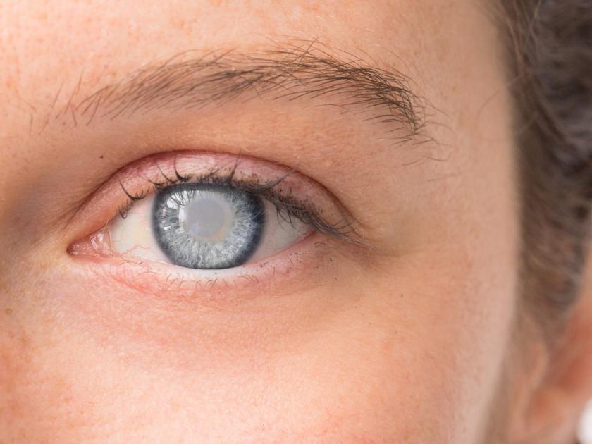 cataract surgery can lower the risk of dementia by 30 percent says study | काय सांगता! मोतीबिंदुच्या ऑप्रेशनमुळे स्मृतीभ्रंश होण्याची शक्यता कमीच, संशोधनच सांगते