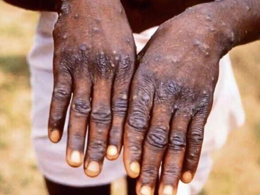 Monkey Pox spread to 19 countries around the world | जगातील १९ देशांत मंकीपॉक्स, लैंगिक संबंधांतून पसरला रोग