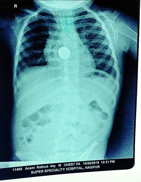 Four-year-old son swallowed cell, a successful operation in the super | चार वर्षीय मुलाने गिळला सेल : ‘सुपर’मध्ये झाली यशस्वी शस्त्रक्रिया