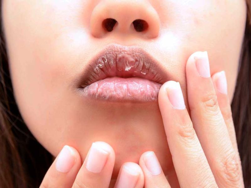 Use these remedies for chapped lips | 'या' सोप्या उपायांनी कधीही फाटणार नाहीत ओठ!
