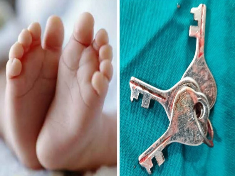 An eighteen month old baby swallowed a bunch of bites Successful treatment by the doctor in just half an hour | अठरा महिन्यांच्या बालकाने गिळला चाव्यांचा जुडगा; अवघ्या अर्ध्या तासात डॉक्टरांनी केले यशस्वी उपचार