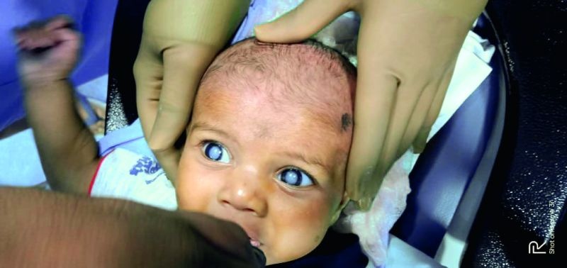 Cataract for a two-month-old baby in Nagpur | नागपुरात दोन महिन्याच्या बाळाला मोतीबिंदू 