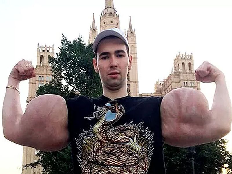 Russian Bodybuilder Kirill Tereshin 24 inch biceps, Hands will have to be cut off too! | ‘सुपरहिरो’ होण्याची वाढती क्रेझ...! २४ इंचाचे बायसेप्स...! हातही कापावे लागणार! 
