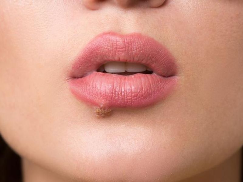 Cold sore and mouth ulcer symptoms and causes home remedies stages treatment prevention | तुम्हालाही कोल्ड सोर झालं आहे का? 'या' गोष्टी करतील मदत!