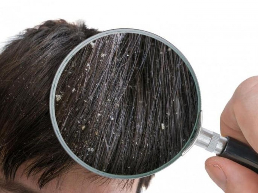 Monsoon hair care tips dandruff problem in monsoon season and home remedies to get rid of it | पावसाळ्यात कोंड्याची समस्या असते कॉमन; ट्राय करा 'हे' घरगुती उपाय