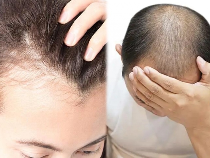 Stress and Hair loss : Scientists uncover why chronic stress can lead to hair loss | Stress and Hair loss :  जास्त टेंशन, स्ट्रेस  घेणाऱ्या लोकांना कमी वयातच पडतं टक्कल; संशोधनातून दावा