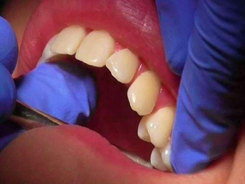 Women removes 11 of her own teeth because she can't afford private dentist | बापरे! Dentist चा खर्च परवडेना; महिलेने स्वत:चं ११ दात उखडून टाकले, ‘अशी’ झाली अवस्था