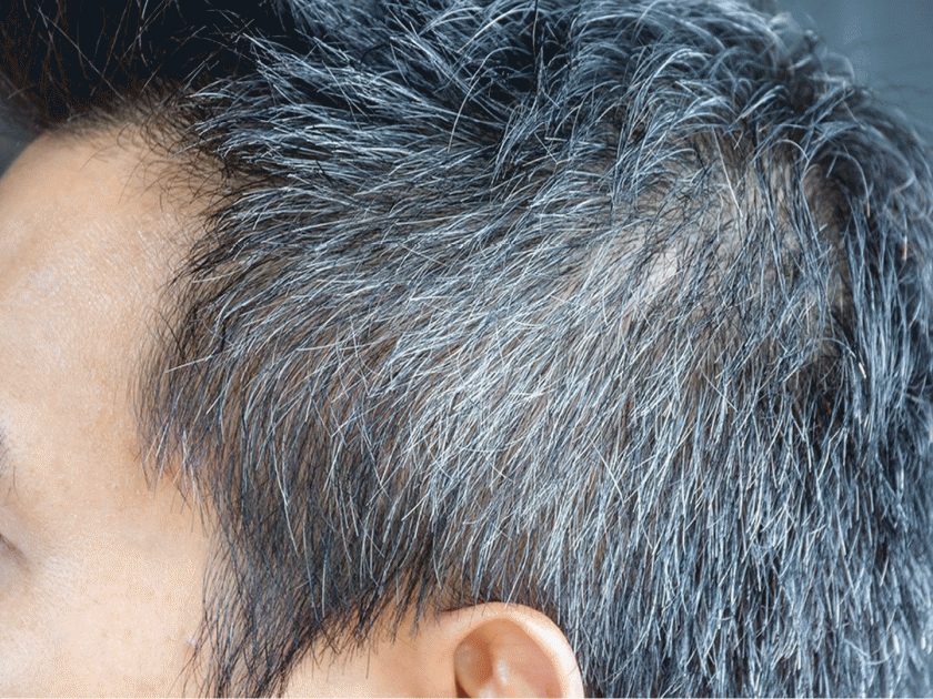 How to take care when you facing problem of hair fall and white hairs | वाढत्या वयात पांढरे आणि गळणारे केस लूक बिघडवतात? तर 'या' टिप्स वापरून केस नेहमी ठेवा चांगले