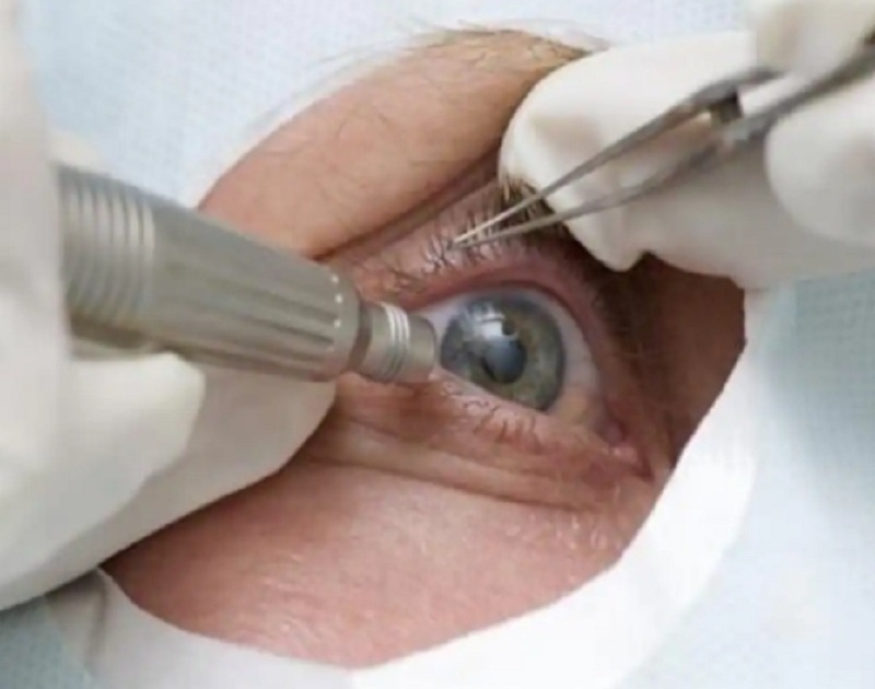 'Darkness' in front of 700 elders; Cataract surgery stopped | ७०० ज्येष्ठांसमोर ‘अंधार’; मोतीबिंदूच्या शस्त्रक्रिया ठप्प