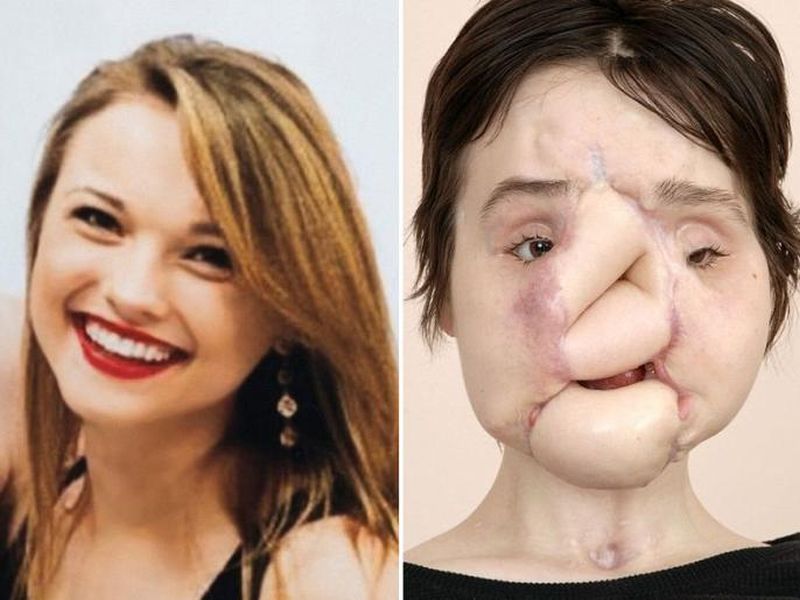 katie stubblefield becomes the youngest person ever to receive a face transplan | shocking... स्वत:वर गोळी झाडल्यानंतरही 'तिला' मिळाले फेस सर्जरीमुळे जीवदान!