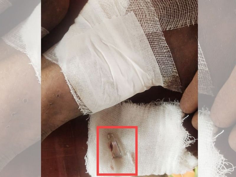 malad wall collapse 2 inch glass removed from patients feet discharged from shatabdi hospital | डिस्चार्ज दिलेल्या रुग्णाच्या पायात २ इंचाची काच; मनसेनं उघडकीस आणला शताब्दी रुग्णालयाचा प्रताप