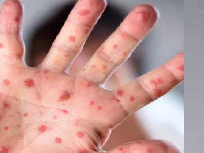 Measles patient in Ratnagiri Chiplun, health system on alert | रत्नागिरीतील चिपळुणात गोवरचा रुग्ण, आरोग्य यंत्रणा सतर्क