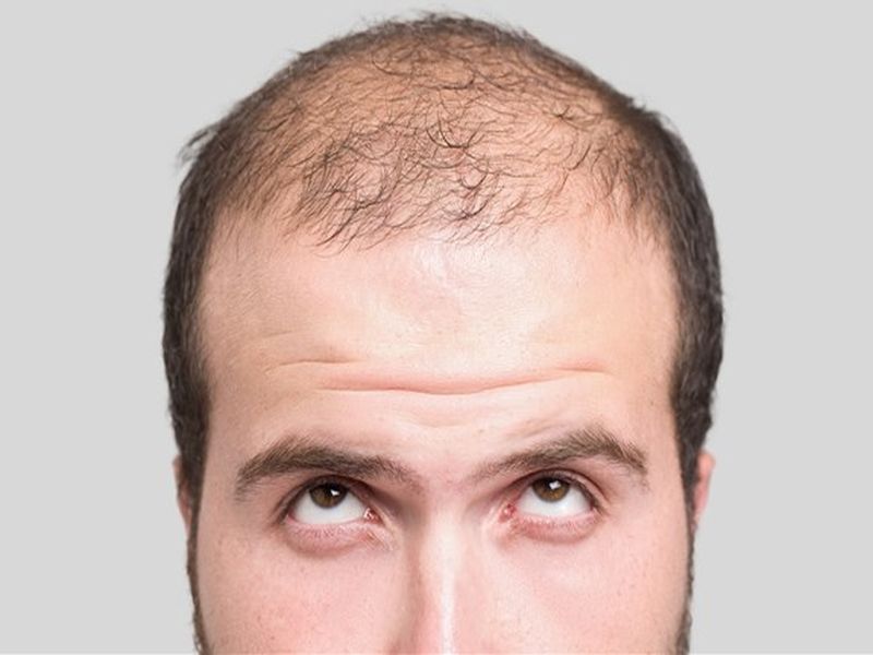 this new medicine may help to solve the problem of baldness and hair fall | 'हे' औषध ठरणार केस गळतीवरील रामबाण उपाय