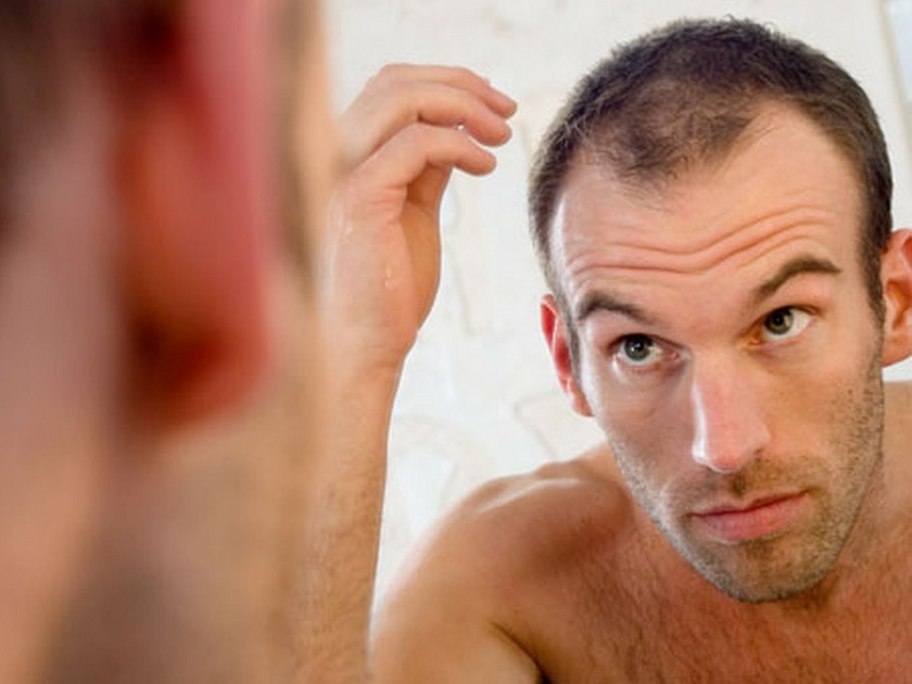 Causes of hair at an early age; Get thicker hair with simple Home remedies | 'या' कारणांमुळे कमी वयातच पुरूषांच्या डोक्याला टक्कल पडतं; सोप्या उपायांनी मिळवा दाट केस