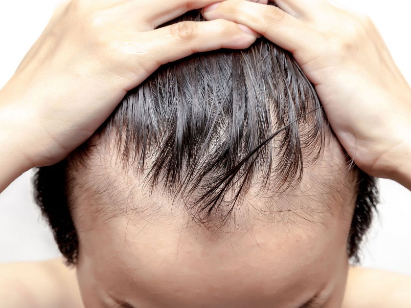These diseases that may cause of hair fall and hair loss | कमी वयातच टक्कल पडण्याला कारणीभूत ठरू शकतात 'या' समस्या, तुम्हाला माहीत आहेत का?