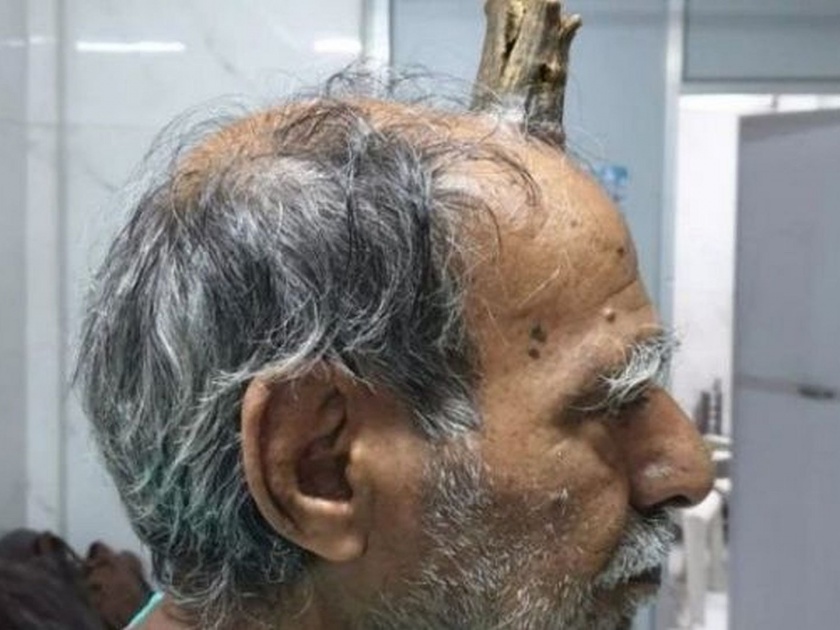 Madhya Pradesh sagar rahli village head horn elderly man shyamlal yadav | 'या' व्यक्तीच्या डोक्यावर उगवलं जनावरांसारखं शिंग, डॉक्टरकडे गेले आणि.....
