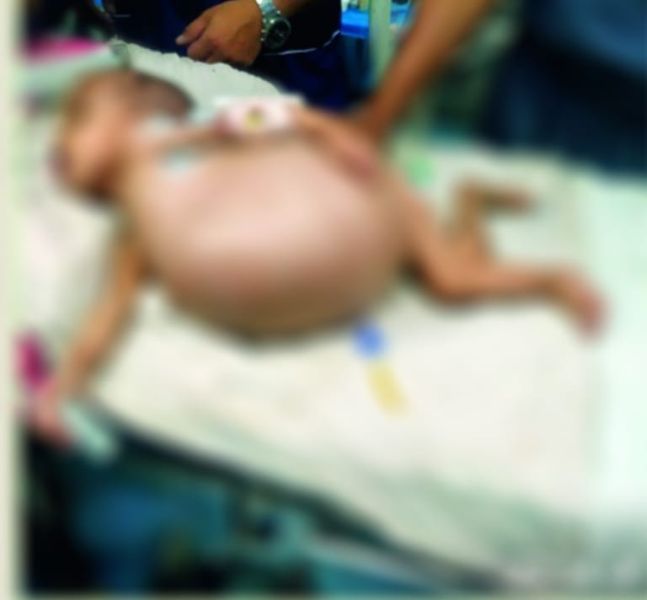 Surprise: By birth fetus in child's stomach: Three cases found in Medical | आश्चर्य : जन्मत: बालकाच्या पोटात गर्भ : मेडिकलमध्ये आढळली तीन प्रकरणे