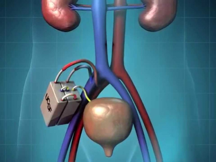 scientist found artificial kidney | गुड न्युज! शास्त्रज्ञांनी तयार केली आर्टिफिशियल किडनी, डायलिसिसचा उपचार सोपे होणार