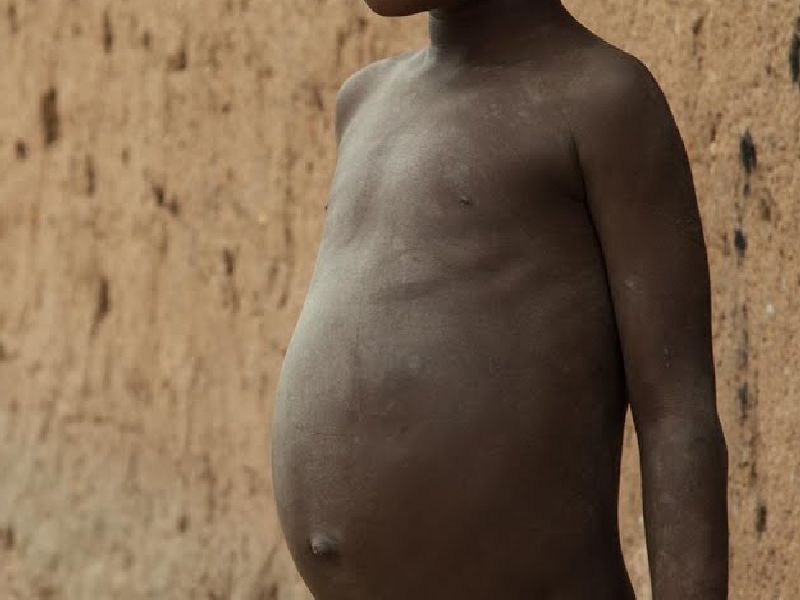 Malnutrition : 37 children have died in 30 days in Balaghat | राज्यात २१ हजार बालके तीव्र कुपोषित, मेळघाटात ३० दिवसांत ३७ बालकांचा मृत्यू