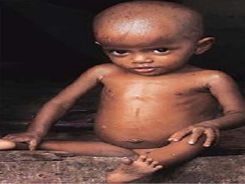 Malnutrition research campaign in Nandurbaraya campaign | अभियानाद्वारे नंदुरबारात कुपोषण शोध मोहीम
