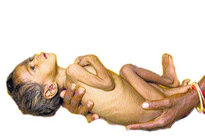 Babies suffering from malnutrition | कुपोषणाचा विळखा