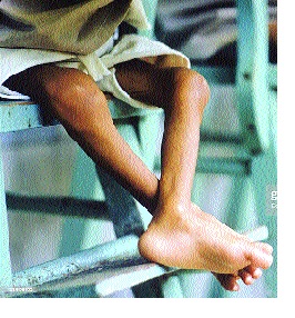 Sindhudurg: 182 children are malnourished and surveyed: Survey of District: Removing Kosala from Malnutrition | सिंधुदुर्ग : १८२ बालके कुपोषणग्रस्त, आरोग्य विभागाचा सर्व्हे : जिल्हा कुपोषणमुक्तीपासून कोसो मैल दूर