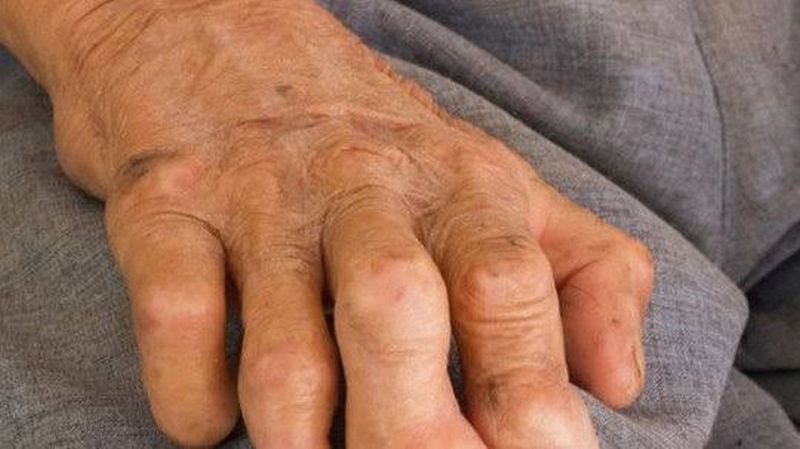 Leprosy NCDR at 5.41 ratio per 10,000 patients | कृष्ठरोगाचा एनसीडीआर ५.४१ वर; दहा हजार रुग्णांमागे ०.४४ प्रमाण