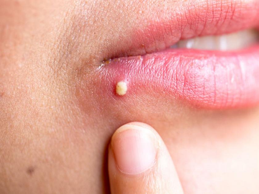 Pimples around lips Causes and home remedies | फार त्रासदायक असतात ओठांवरील पिंपल्स; असा करा बचाव