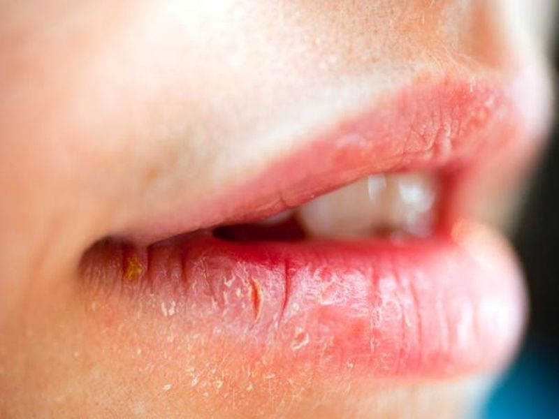How to remove darkness of the lips by using home remedies myb | सुट्टीचा फायदा करून सौंदर्य खुलवा,ओठांचा काळपटपणा 'या' सोप्या पद्धतीने घालवा