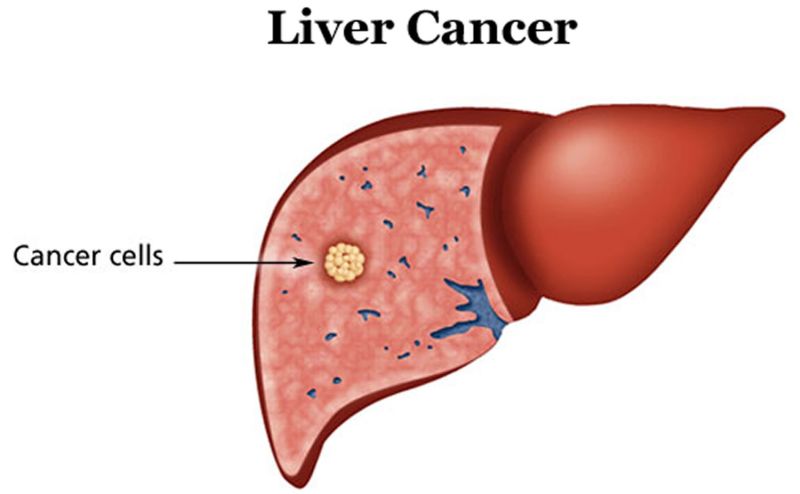 The fifth reason for death is Liver Cancer: Dr. Gaurav Gupta | मृत्यूचे पाचवे कारण लिव्हर कॅन्सर  : डॉ. गौरव गुप्ता