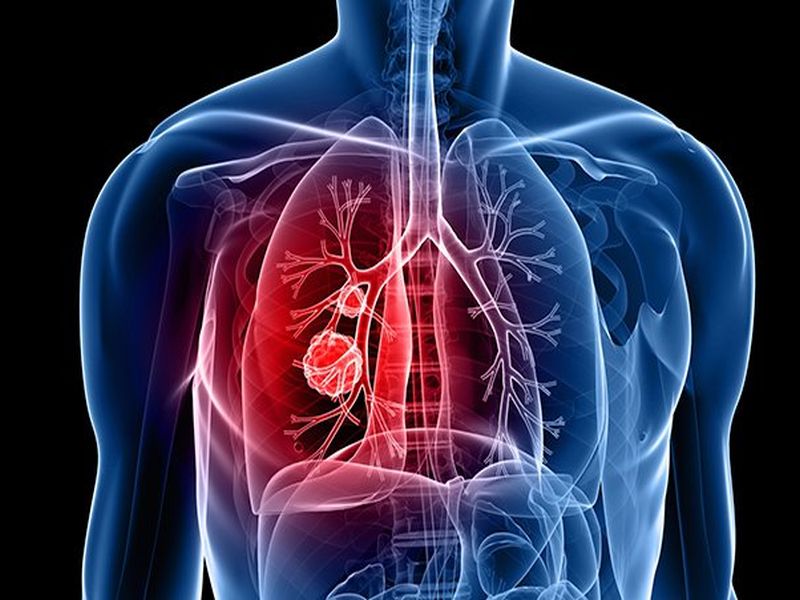 Lung Cancer Awareness Month 2018 : Do not ignore these symptoms | Lung Cancer Awareness Month 2018 : फुफ्फुसाच्या कर्करोगाची लक्षणे, चुकूनही करु नका दुर्लक्ष!