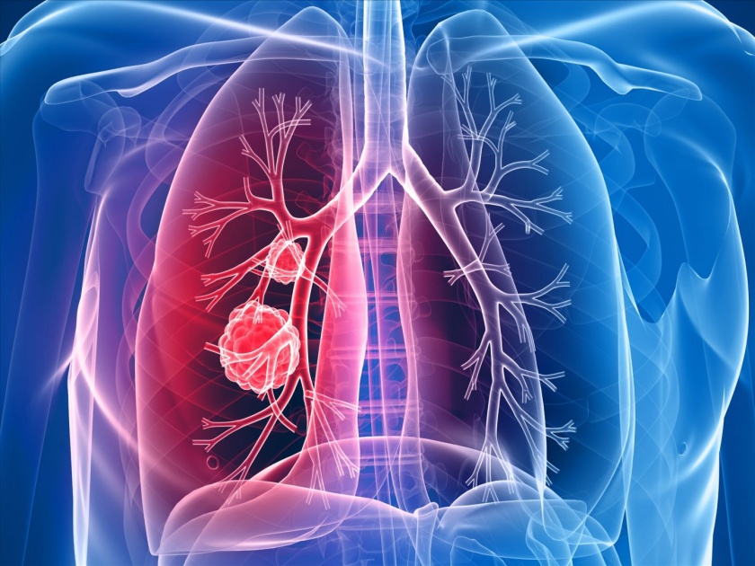 Lung cancer Awareness Month know the sign and symptoms of lung cancer | चुकूनही 'या' लक्षणांकडे करू नका दुर्लक्षं; होऊ शकतो फुफ्फुसाचा कॅन्सर