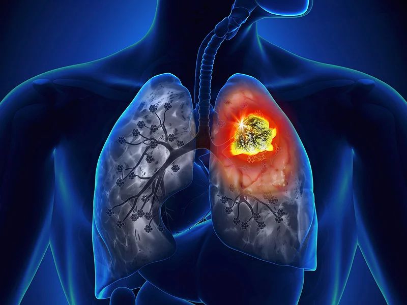 lung cancer awareness month 2018 do not ignore these symptoms it may be lung cancer | Lung Cancer Awareness Month : 'ही' असू शकतात फुफ्फुसांच्या कॅन्सरची लक्षणं; चुकूनही दुर्लक्ष करू नका!