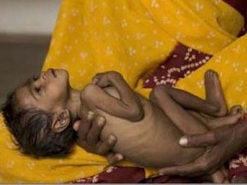 Worried! 17,000 children malnourished in Aurangabad district; The ratio is continuing from year to year | चिंताजनक ! औरंगाबाद जिल्ह्यात १७ हजार बालके कुपोषित; वर्षभरापासून प्रमाण कायम 